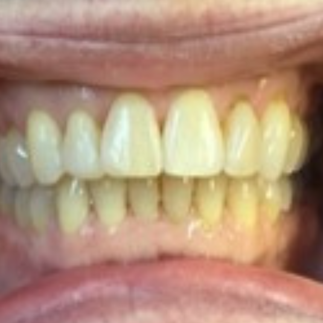 Invisalign After 1